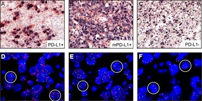 Tumor Immune Microenvironment Components and Checkpoint Molecules in Anaplastic Variant of Diffuse Large B-Cell Lymphoma